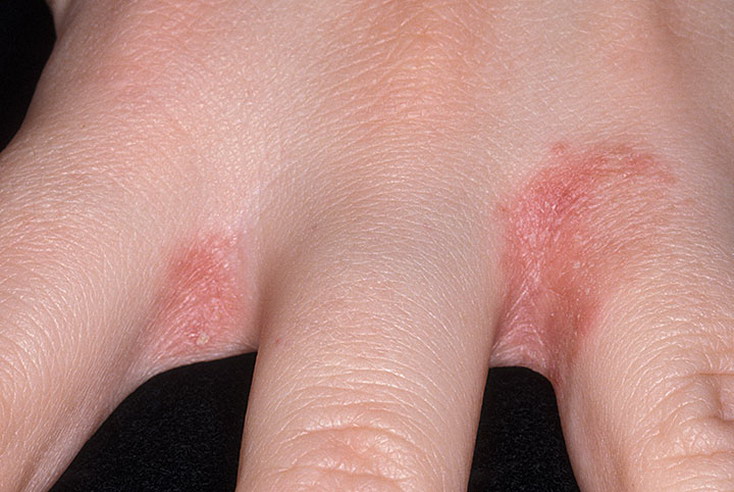 grzybica miedzy palcami dłoni leczenie