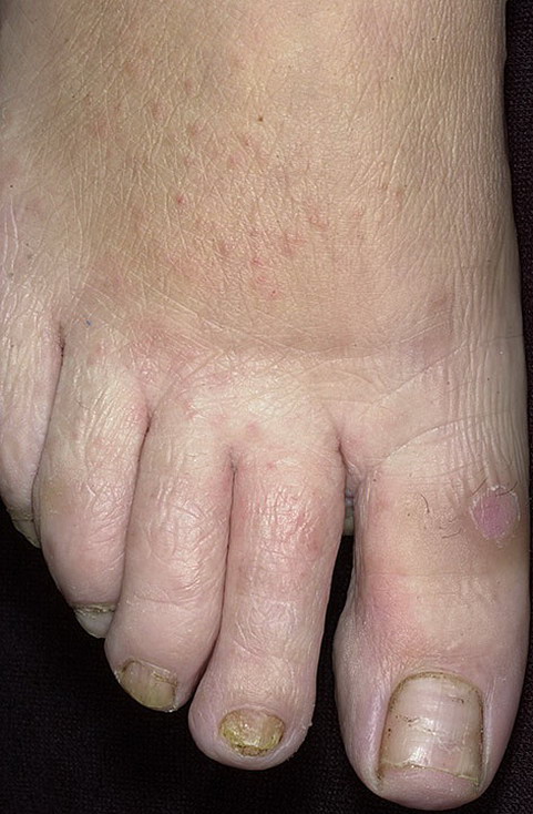 grzybica między palcami u nóg objawy