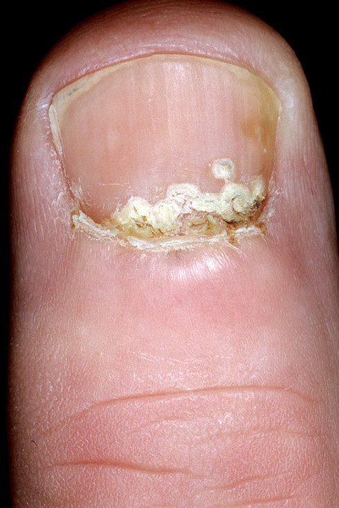 grzybica paznokci z bliska