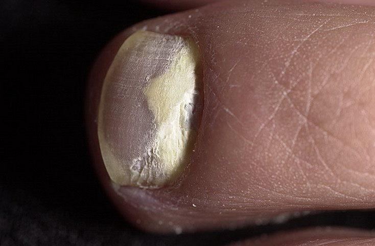 grzybica paznokci z bliska u nóg