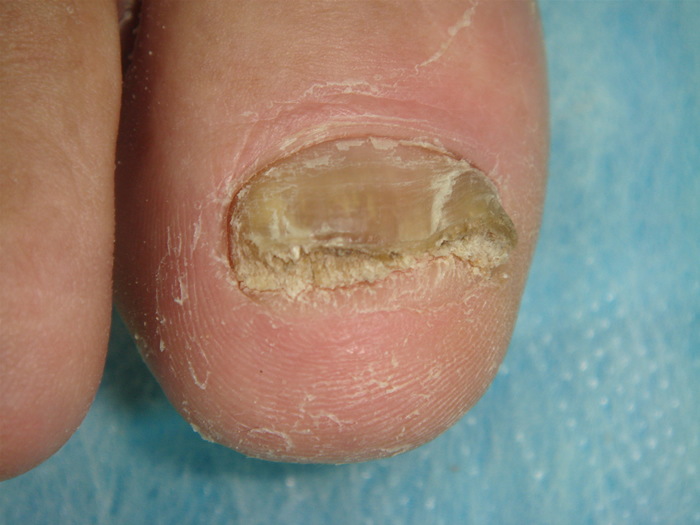 grzybica paznokcia 
