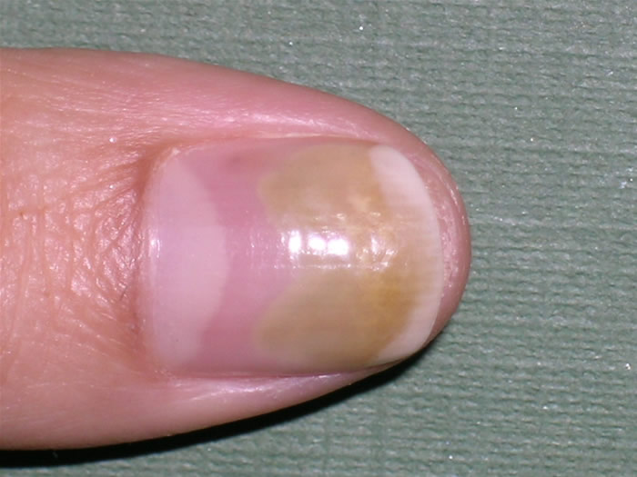 grzybica paznokcia jak wygląda