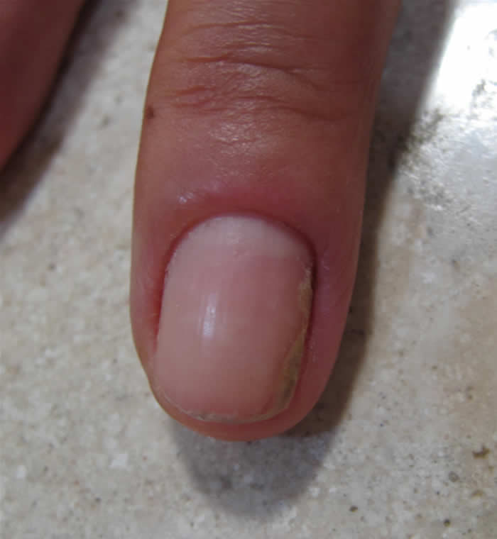 grzybica paznokcia palca dłoni