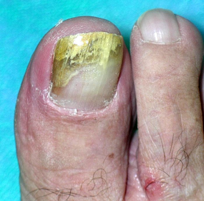 grzybica paznokcia palca nogi