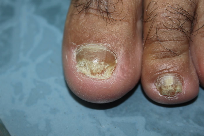 grzybica paznokcia stóp 