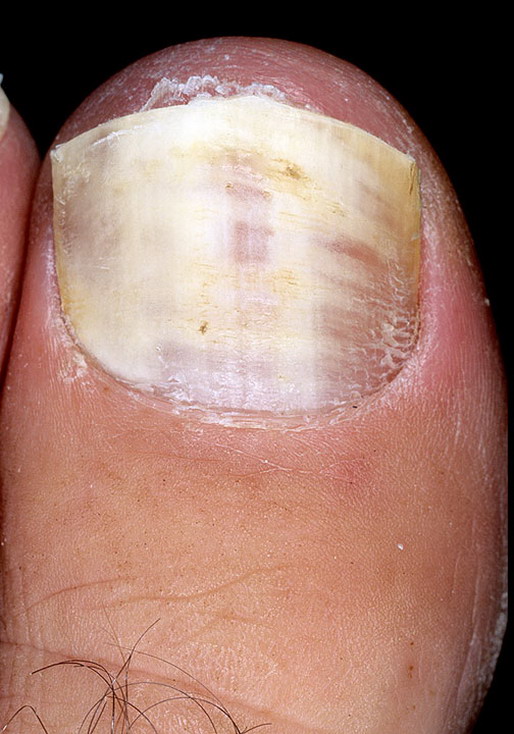 grzybica paznokcia w nodze
