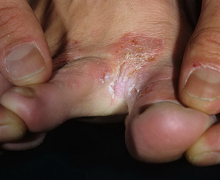 grzybica skóry między palcami