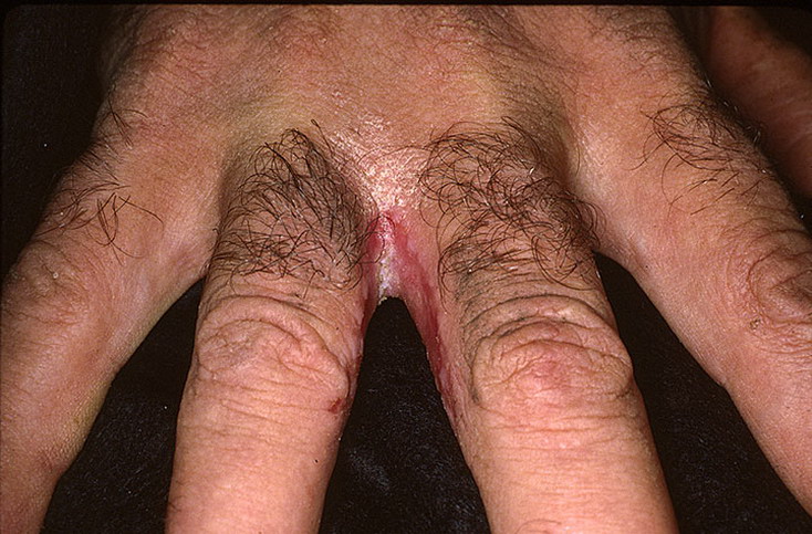 grzybica skóry palców