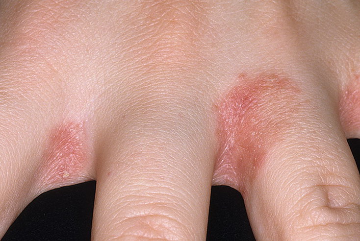 grzybica skóry palców dłoni