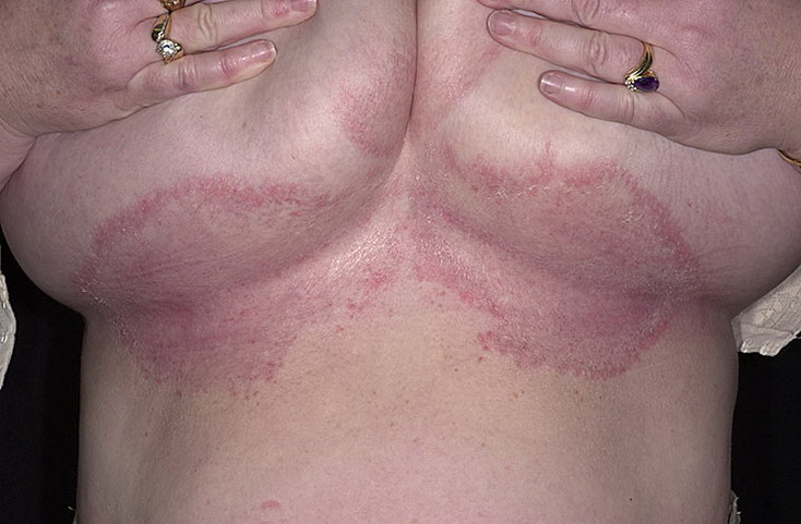 grzybica skóry pod piersiami leczenie