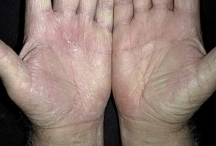 Grzybicze choroby skóry dłoni