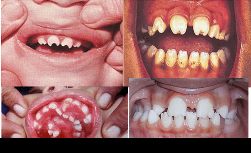 kiła syfilis wrodzony zdjęcia jamy ustnej