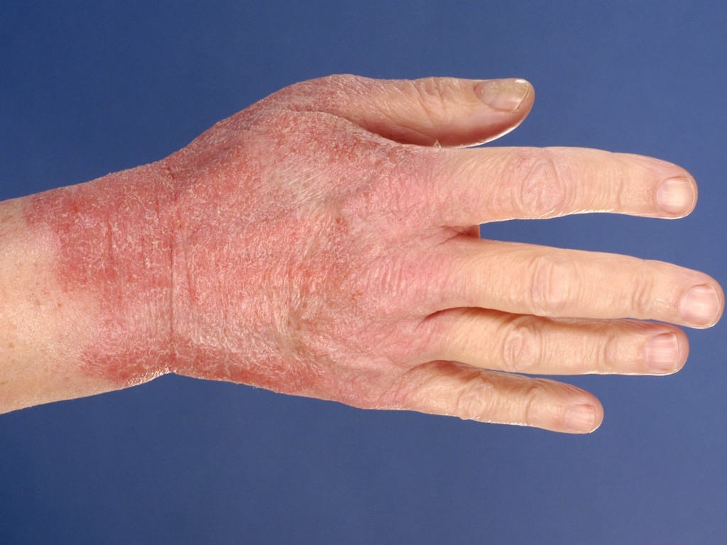 kontaktowe zapalenie skóry dłoni