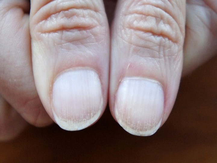 Łamliwe paznokcie zdjęcia