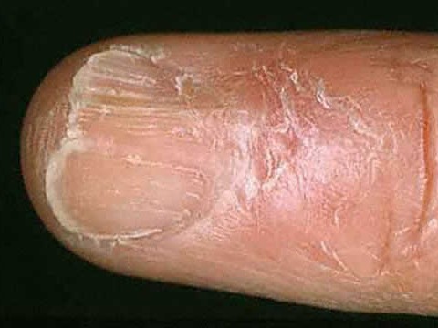 liszaj płaski paznokci objawy