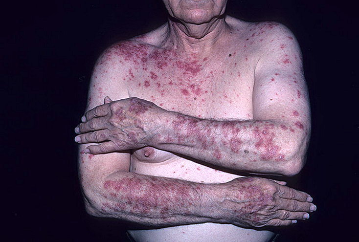 lupus wilcza choroba