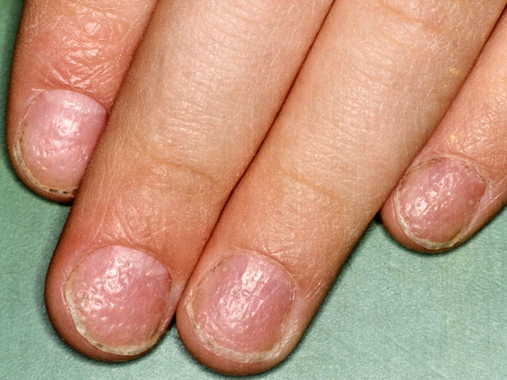 łuszczyca paznokci