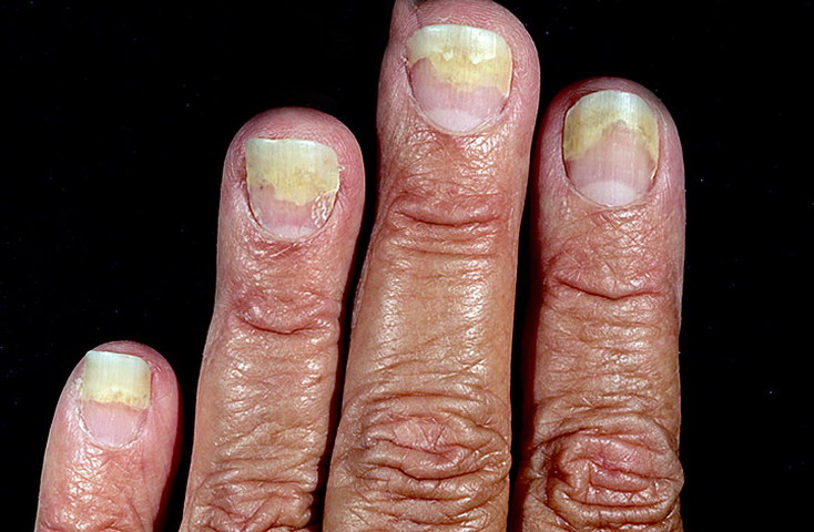 łuszczyca paznokci u rąk 