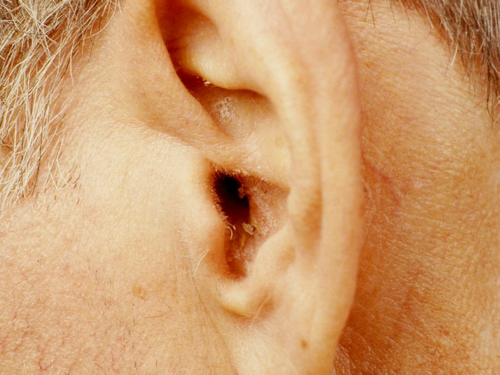 łuszczyca ucho