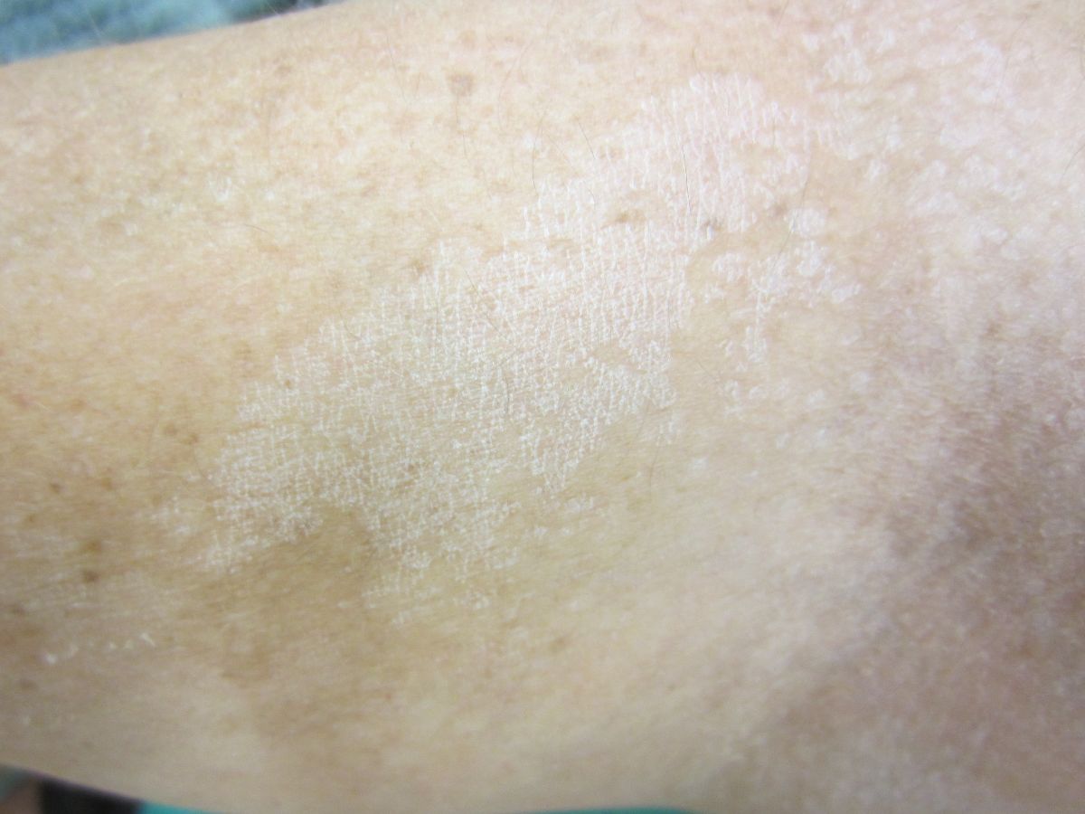 malassezia furfur skin