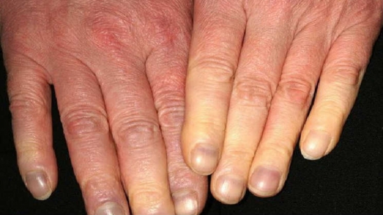 objaw raynauda w obrębie skóry palców