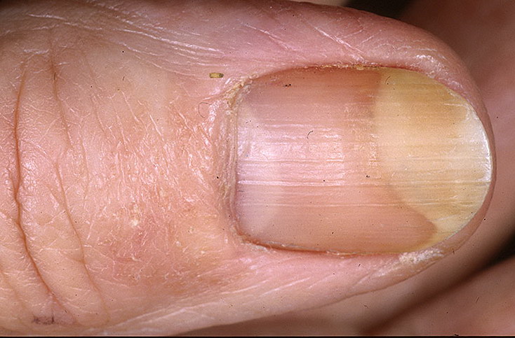 odwarstwianie paznokcia palca