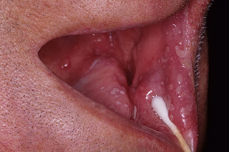 opryszczka w jamie ustnej