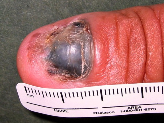 paznokcie choroby zdjęcia