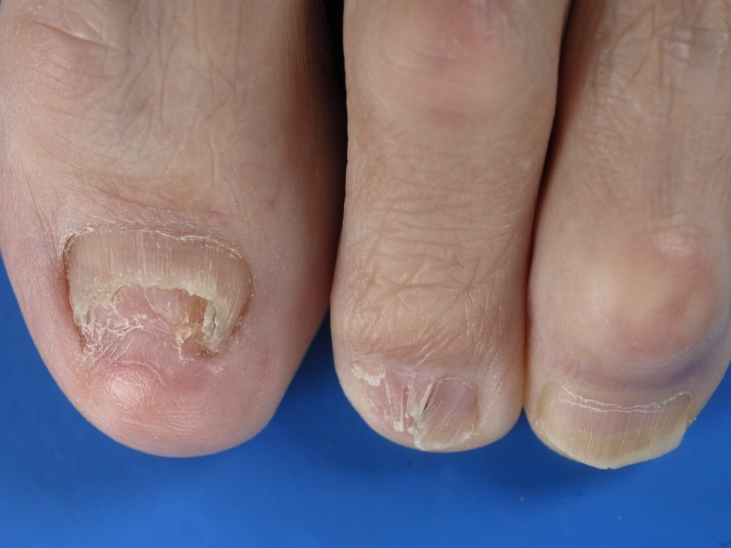 paznokcie u nóg choroby
