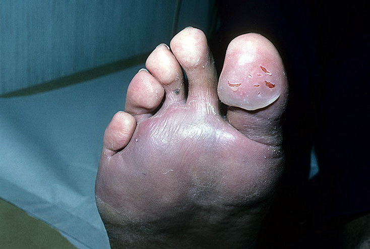 pęcherzyca stopa palec duży