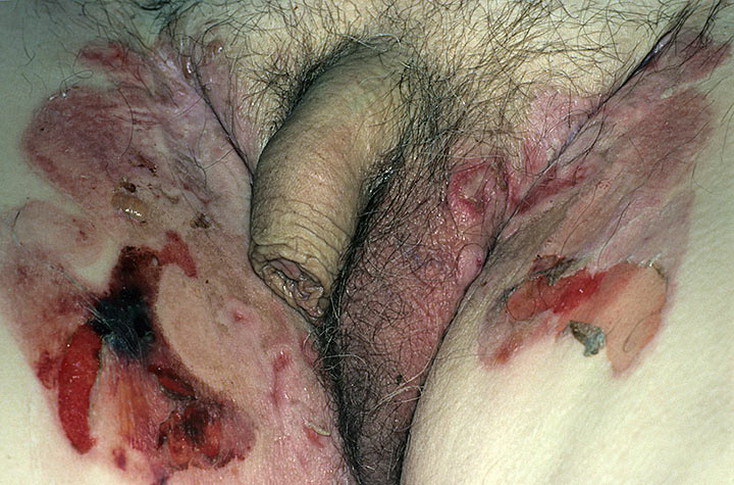 pemfigoid pęcherzowy genitalia