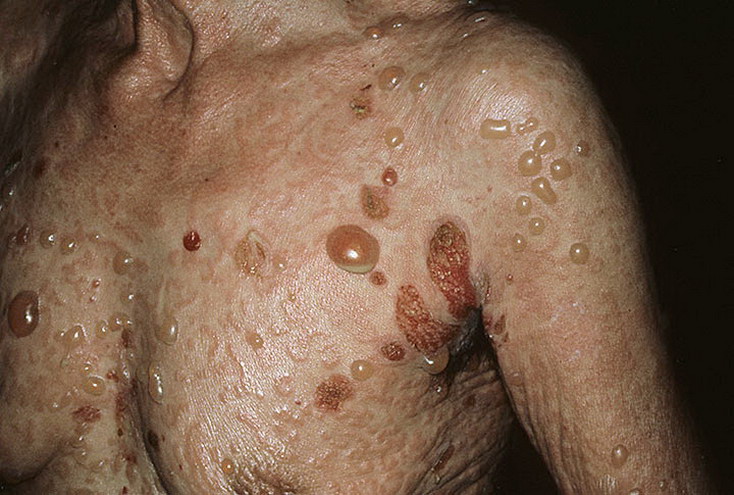 pemfigoid pęcherzowy na ciele kobieta