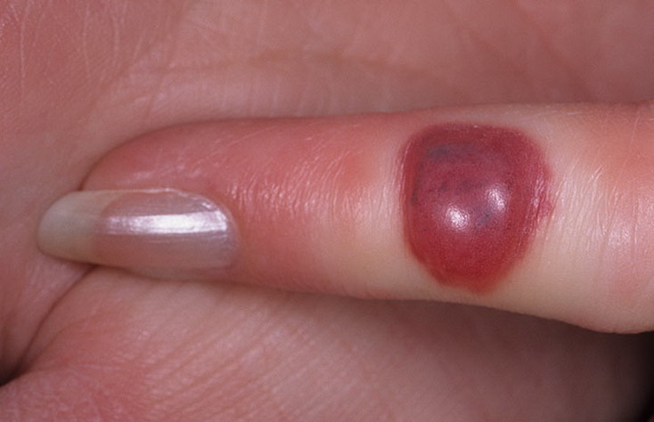 pemfigoid pęcherzowy na palcu