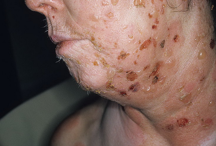 Pemfigoid pęcherzowy na twarzy