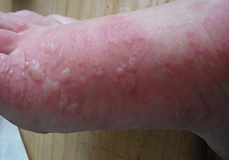 phytophotodermatitis pictures
