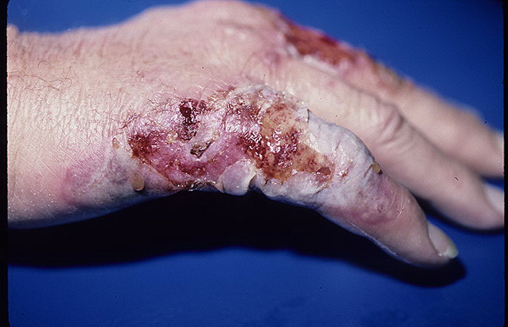 piodermia zgorzelinowa skóry dłoni
