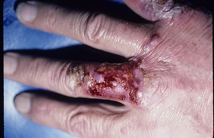 piodermia zgorzelinowa skóry palca ręki