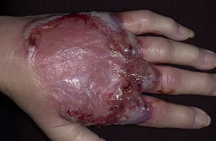 piodermia zgorzelinowa skóry ręki
