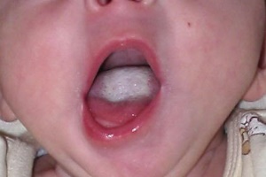 pleśniawki w jamie ustnej noworodka 