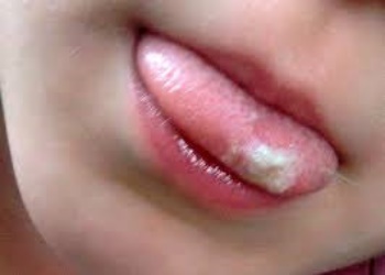 Przewlekłe drożdże w jamie ustnej 