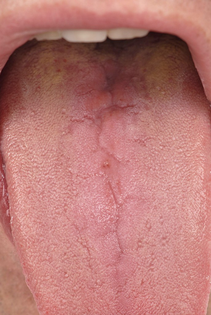  romboidalne zapalenie grzbietu języka