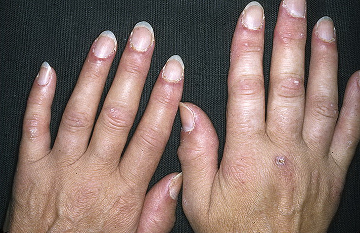 zapalenie skórno mięśniowe na dłoniach i palcach
