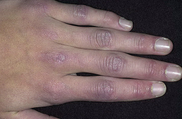 zapalenie skórno mięśniowe rąk palcy