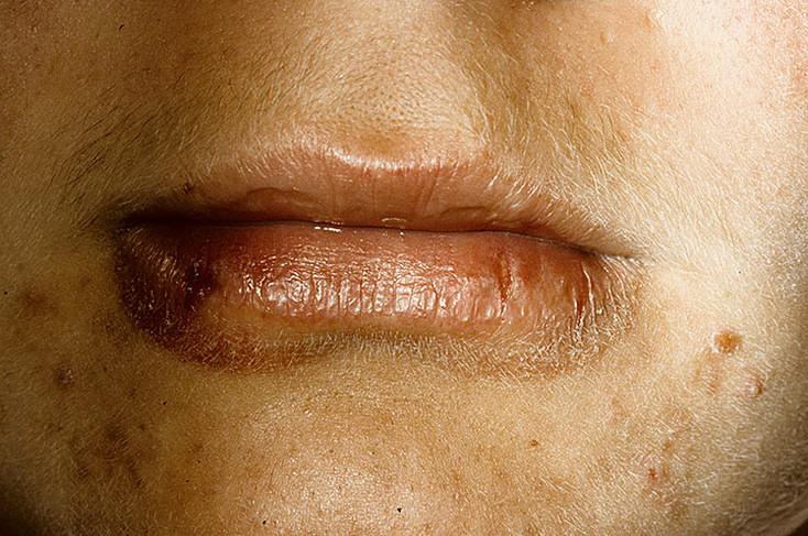 zapalenie skóry koło ust