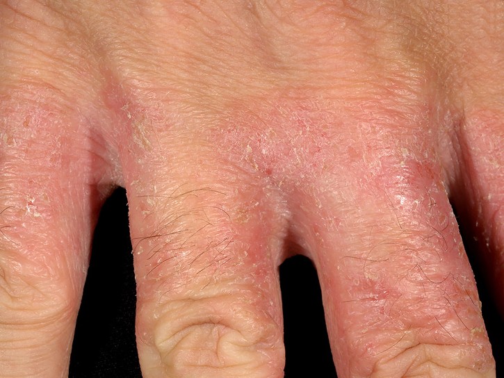 zapalenie skóry między palcami