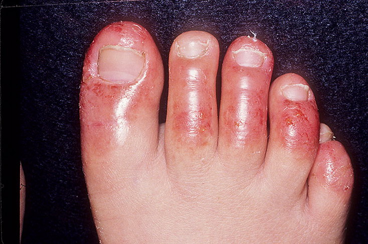 zapalenie skóry palców u nóg