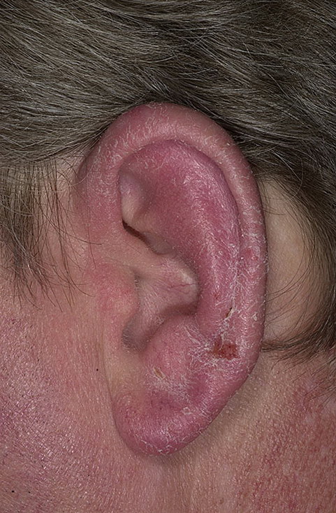 zapalenie skóry ucha