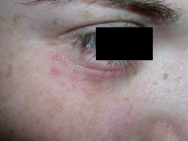 zapalenie skóry wokół oczu dziecka