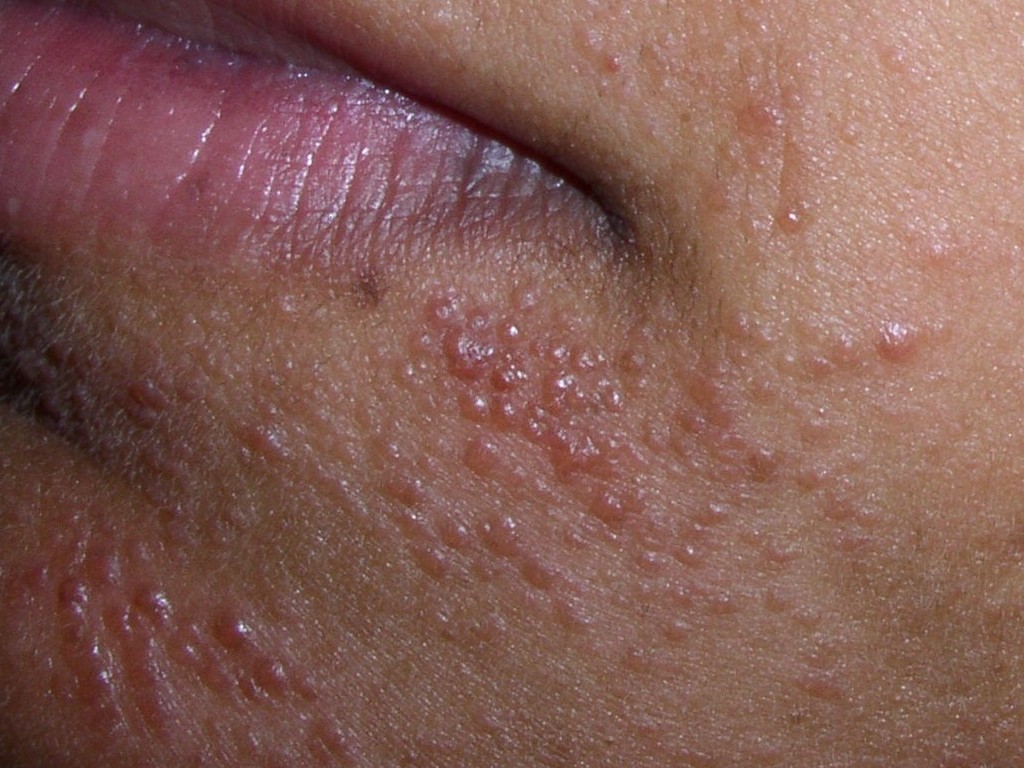 zapalenie skóry wokół ust