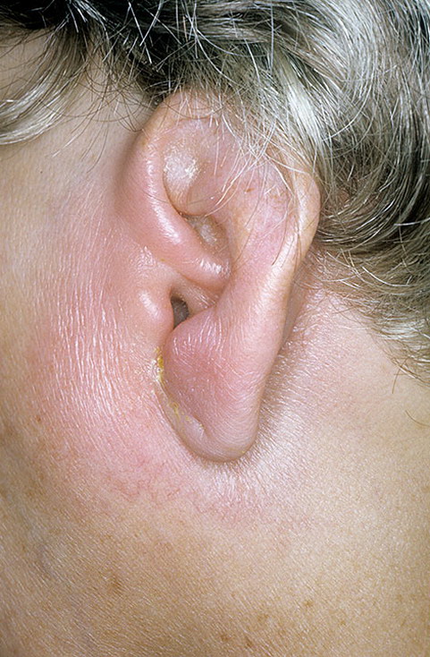 zapalenie ucha objawy u dorosłych